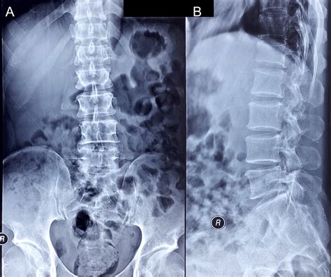 Cureus Lumbar Schwannoma As A Rare Cause Of Radiculopathy In The