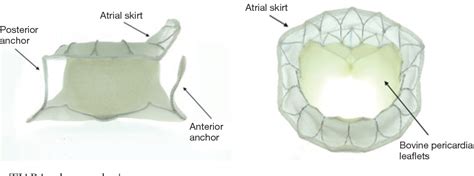 Figure 1 From Early Experience Of Tiara Transcatheter Mitral Valve