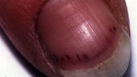 Black Line On The Nail Causes Treatments Pictures And More