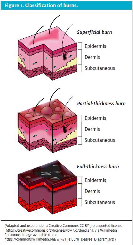 An Urgent Care Approach To Burns