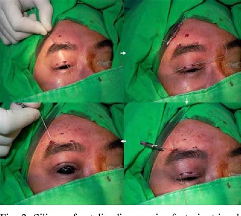 Figure From The Impact Of Silicone Frontalis Suspension With Ptosis