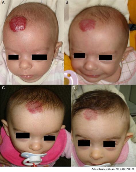 Propranolol In The Treatment Of Infantile Hemangioma Clinical