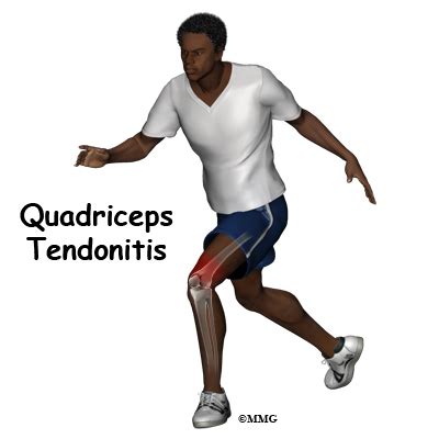 Five simple stretches / front leg musclevtendon ~ anatomy stock images | lower leg. Quadriceps Tendonitis | eOrthopod.com