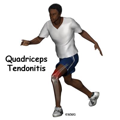 Depending on the reason for the deformity, there can be a breed or. Quadriceps Tendonitis | eOrthopod.com
