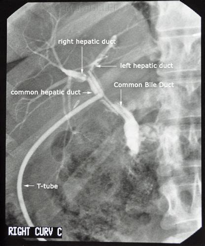 Ercp Note T Tube Anatomia Patologica Rayos X Neurociencia