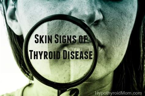 Also, although hirsutism doesn't cause physical complications, the underlying cause of a hormonal imbalance can. Skin signs of thyroid disease | Hypothyroid Mom