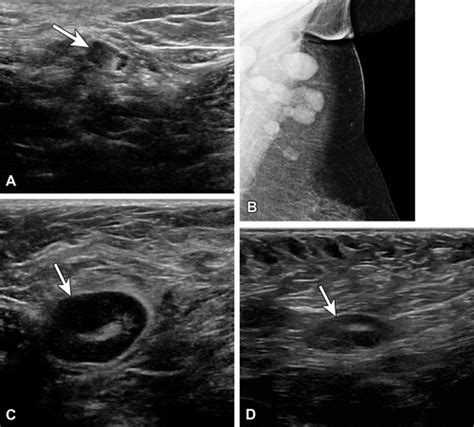 Axillary Lymphadenopathy In The Covid 19 Era What The Radiologist
