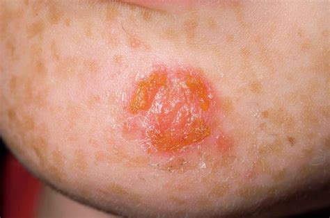 Impetigo Infection On Chin Photograph By Dr P Marazziscience Photo