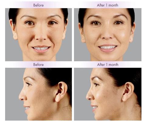Juvederm Before And After Photos Juvederm Costs And Side Effects