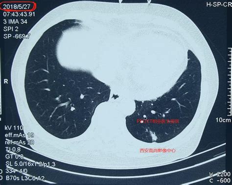 肺结节看诊（12）：体检发现实性肺结节未重视，3年后发生了什么 每日头条