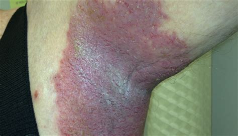 It could be a sign of an sti or cancer. Derm Dx: Long-term, recurring rash in axillae, groin folds ...