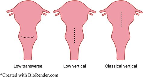 Cesarean Section Incision Types