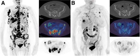Molecular Imaging Of Bone Metastases And Their Response To Therapy