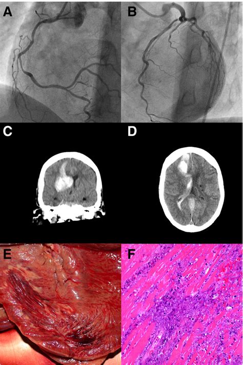 Figure 1 From Intracranial Hemorrhage Causes A Transmural Myocardial