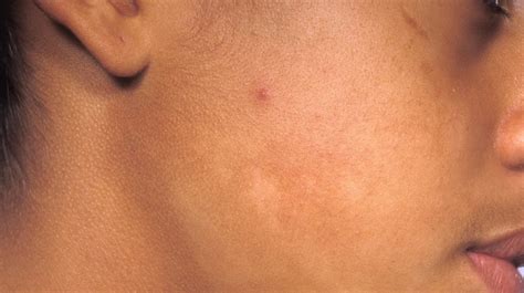 White Spots On The Skin Possible Causes And Treatments 45 Off