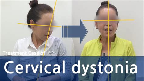 dystonia cervical dystonia spasmodic torticollis 사경증 치료사례 근긴장이상증 youtube