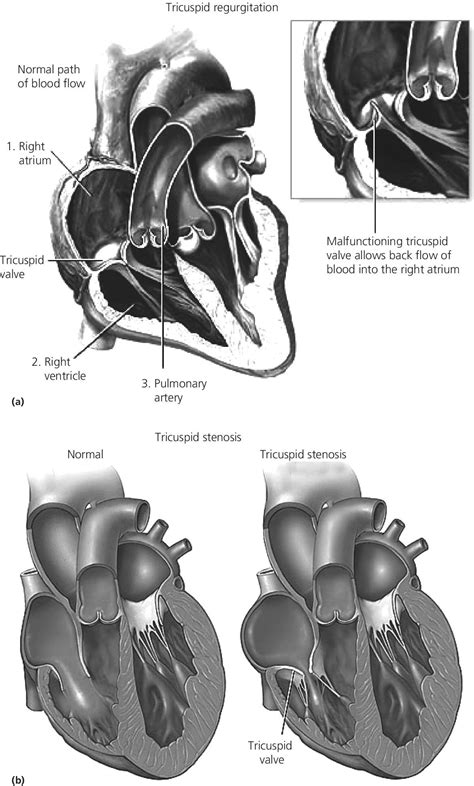 13 The Tricuspid Valve Thoracic Key