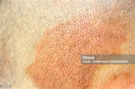 Psoriasis On Skinhead Stock Photo Download Image Now Dry Skinhead