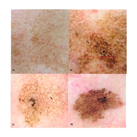 Dermatoscopy Of Flat Pigmented Facial Lesions—evolution Of