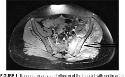 Figure 1 From Iliopsoas Abscess With Septic Arthritis Of The Hip