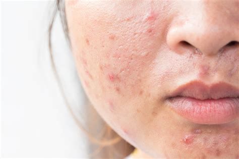 The Different Types Of Acne Scars And Ways To Get Rid Of Them Better Off