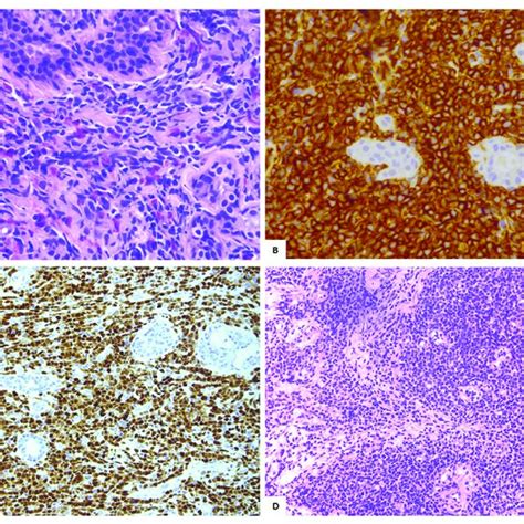 A Isolated Myeloid Sarcoma Ms Involving The Right Breast H E