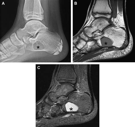Primary Osseous Tumors Of The Foot And Ankle Magnetic Resonance Imaging Clinics