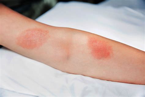 How To Identify These Three Common Rashes Parkview Health