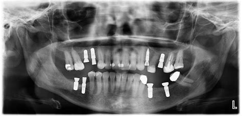 Dental X Rays And Imaging Done For Dental Implant Procedure
