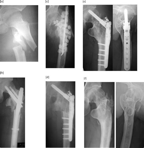 Radiographs In Case 1 A Anteroposterior Ap Radiograph Of The Left