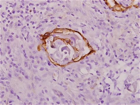 Invasive Penile Squamous Cell Carcinoma Mdedge Dermatology