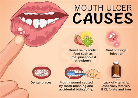 Mouth Sores Everything You Need To Know Clinica Dental Tenerife Sur