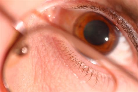 Mydriasis What Causes Your Pupils To Dilate And How To Treat