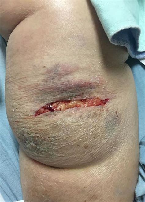 Soft tissue laceration caused by lower extremity intraosseous access ...