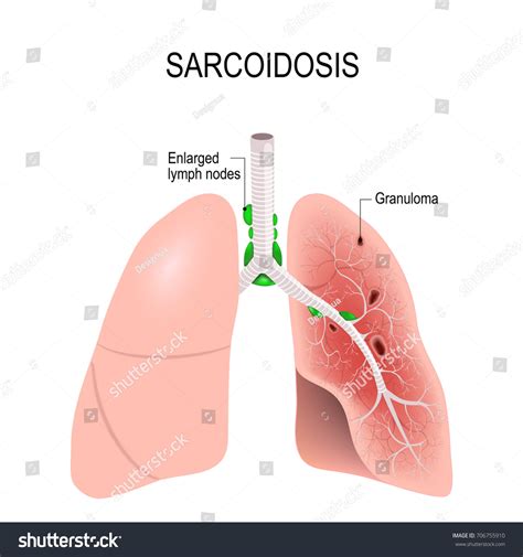 Sarcoidosis Humans Lungs Granulomas Enlarged Lymph Stock Vector