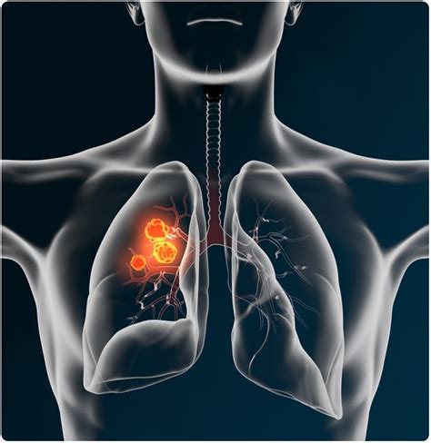 Lung Cancer Radiotherapy And Chemotherapy