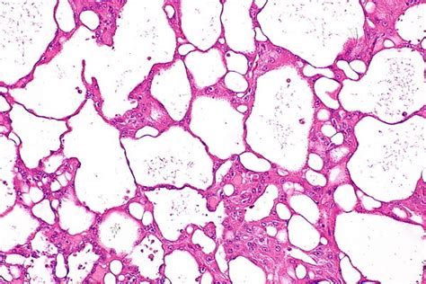 Acquired Cystic Disease Associated Renal Cell Carcinoma Libre Pathology