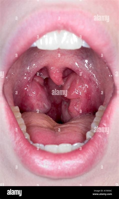 Strep Throat Infection Stock Photo Alamy