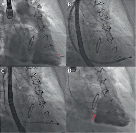 Frontiers Transcatheter Tricuspid Valve Intervention Coaptation Devices