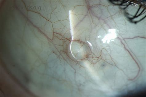 Atlas Entry Conjunctival Epithelial Inclusion Cyst
