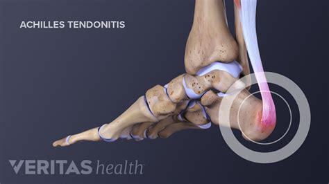 Achilles Tendonitis And Tendon Injuries Sports Health