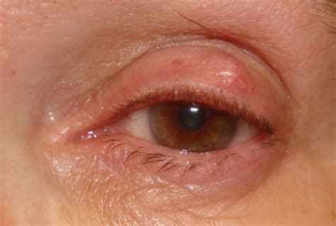 Bump On Eyelid Causes Symptoms Treatment Prevention Healthmd
