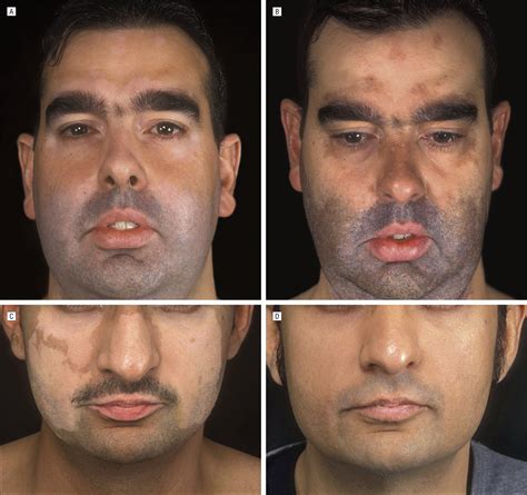 Randomized Double Blind Trial Of Treatment Of Vitiligo
