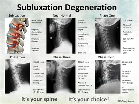 Chiropractic Subluxation Degneration Poster Cervical Etsy