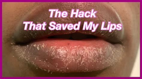 Heal Your Extremely Drycrackedpeeling Lips Fast Eczema 003 Youtube