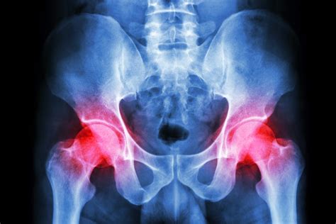 Hip Bursitis Symptoms And Treatment Plans Orthoindy Blog