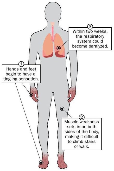 Symptoms of Guillain Barré Syndrome Marler Clark