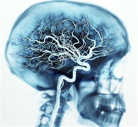 Cerebral Vessels Blood Flow In The Brain Medizzy