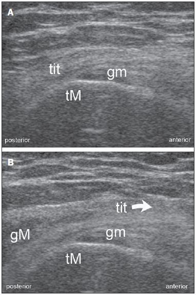 Radiologia Brasileira Ultrassonografia Do Trato Iliotibial Espectro