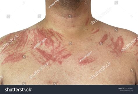 Dermatographia Dermographism On Skin Stock Photo 1321408463 Shutterstock
